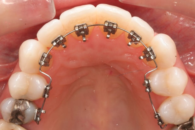 ortodonzia-linguale