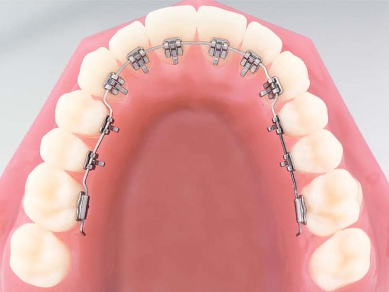 Ortodonzia linguale