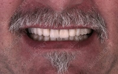 Bez brušenja zuba do novog osmijeha – Aditivna stomatologija
